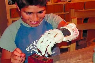 Argentina:Fabrican mano con impresora 3D para niño