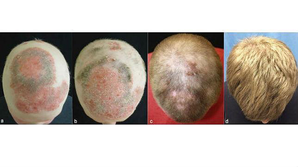 Un medicamento para la artritis cura la alopecia