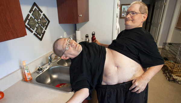 Dos gemelos siameses llevan 62 años unidos por la cintura