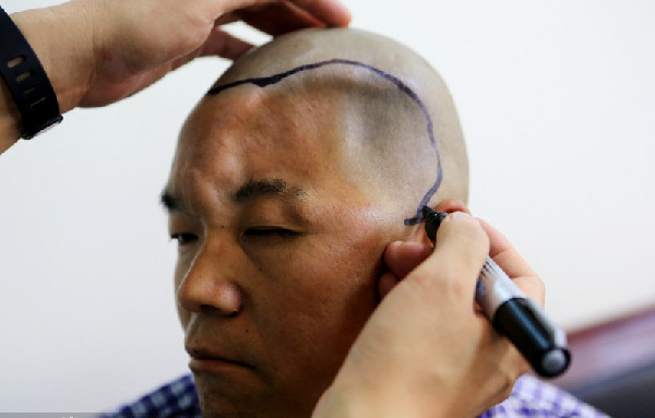 Hu, de 46 años de edad, perdió la mitad de su cráneo en un accidente. Durante una operación, se le implantará un soporte craneal personalizado de titanio, creado con tecnología de impresión 3D.