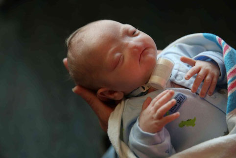 Nace un bebé sin nariz en EE.UU
