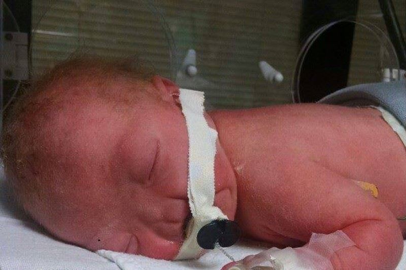 Nace un bebé sin nariz en EE.UU
