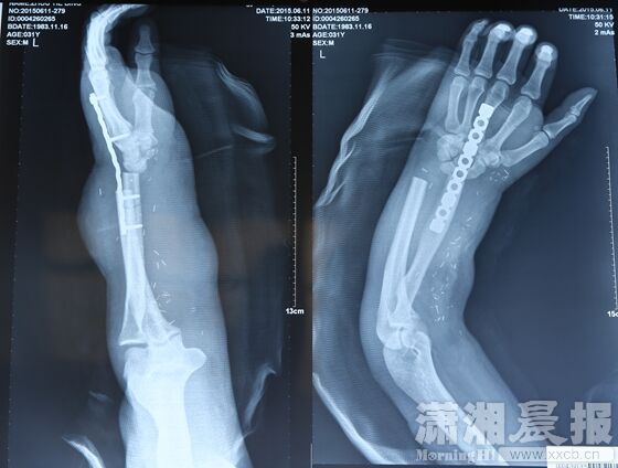 Cirujanos chinos salvan la mano de un paciente pegándosela a la pierna