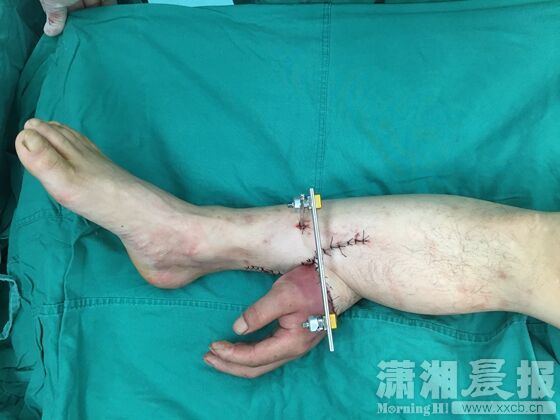 Cirujanos chinos salvan la mano de un paciente pegándosela a la pierna