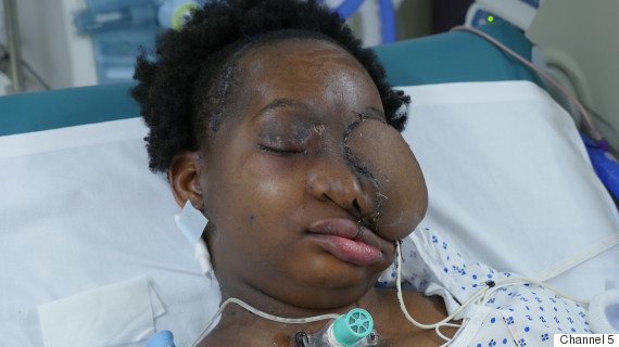 Retiran un tumor de 2 kilos de la cara de una joven sudafricana