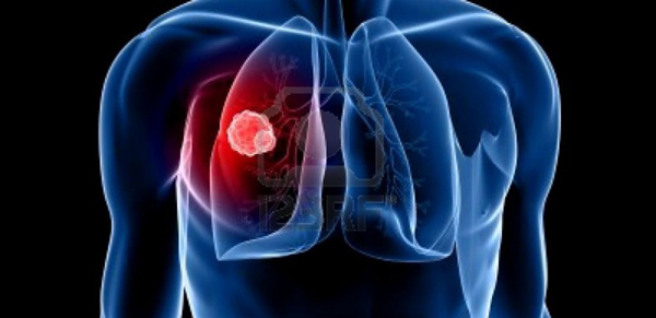 El cáncer de pulmón, la primera causa de muerte por tumor en el mundo