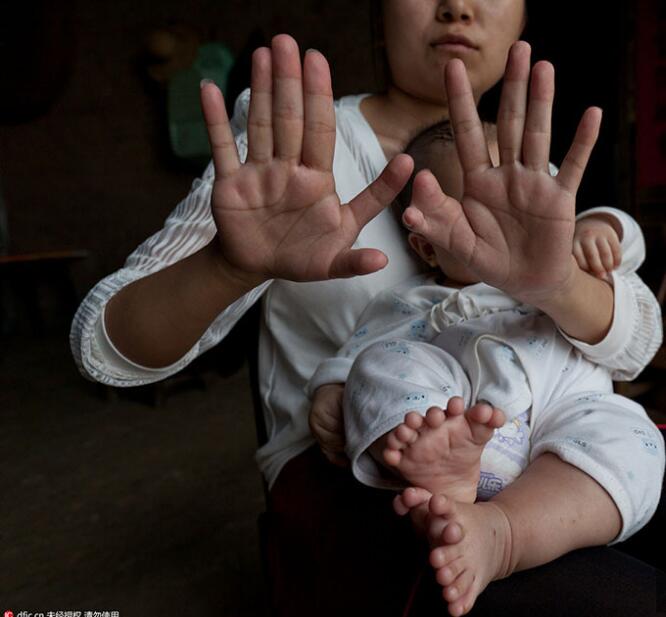 Los padres de un bebé con 31 dedos piden ayuda para su operación