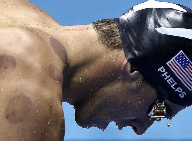 ¿A qué se deben los círculos rojos en la espalda de Phelps?
