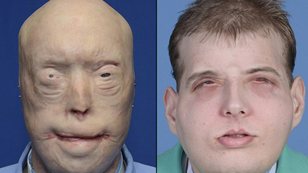 La nueva vida de Patrick Hardison, el hombre con trasplante total de cara