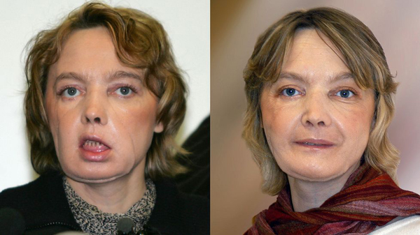 Muere la mujer francesa que recibió el primer trasplante mundial de cara