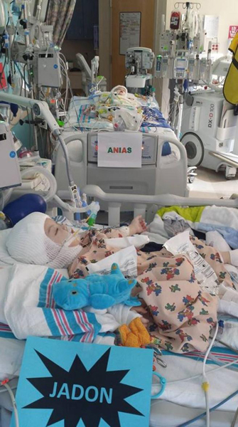 Los gemelos siameses separados con éxito abren los ojos por primera vez tras la operación