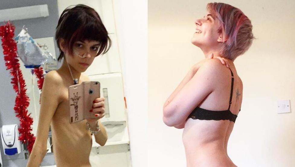 Joven británica demuestra que hay vida después de la anorexia
