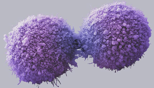 Dos tercios de las mutaciones genéticas que causan cáncer son debidas al azar