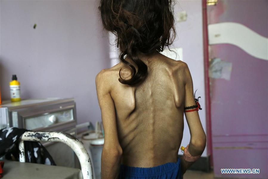 El hambre y la desnutrición: asesinos silencios de niños en Yemen