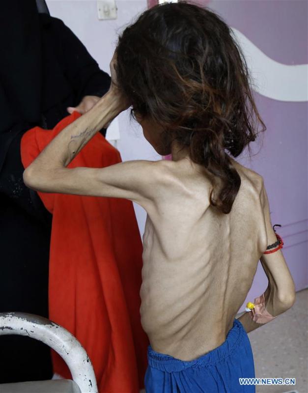 El hambre y la desnutrición: asesinos silencios de niños en Yemen