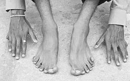 Hombre indio orgulloso de sus 12 dedos de la mano y 14 del pie