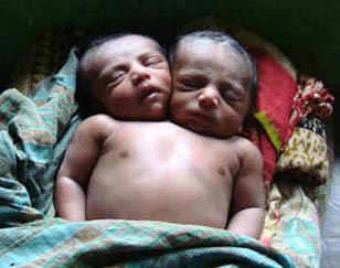 Bangladesh: Un niño nacido con dos cabezas y dos bocas capaces de comer normalmente