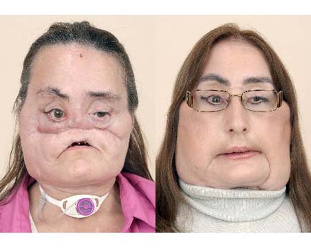 La primera paciente de transplante de cara de EE.UU. muestra su rostro