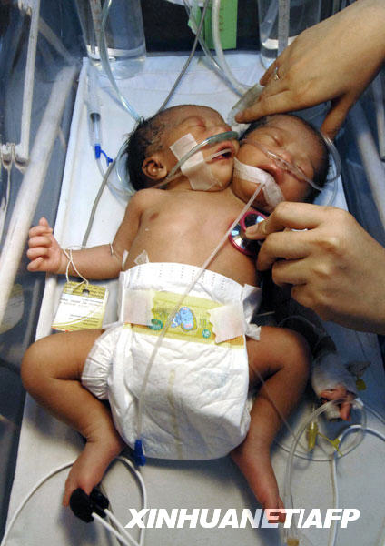 Nace niña con dos cabezas en Filipinas
