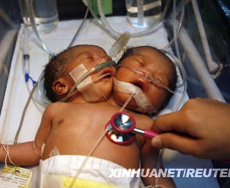 Nace niña con dos cabezas en Filipinas
