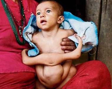 Nepal: Bebé con 4 brazos y 4 piernas considerado por habitantes locales como divinidad