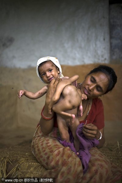 Niño nepalés con 4 manos y 4 piernas es considerado como reencarnación de divinidad