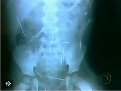 Descúbrense 50 agujas de coser en cuerpo de un niño brasileño