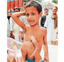 Nuevos hermanos siameses en India: un niño de ocho años tiene brazos y piernas de su hermano gemelo en el abdomen